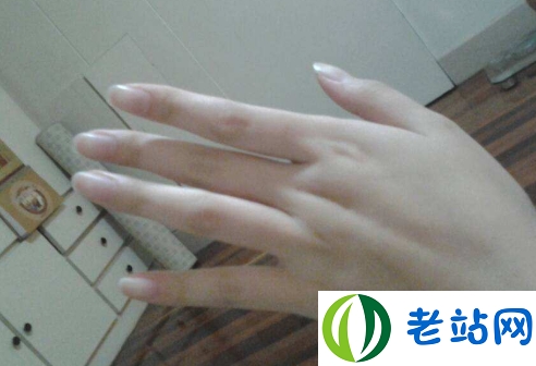 手指甲发黑是什么病 灰指甲是营养不良引起的吗2