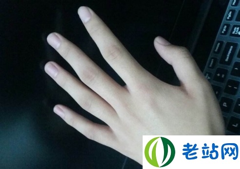 手指甲发黑是什么病 灰指甲是营养不良引起的吗3